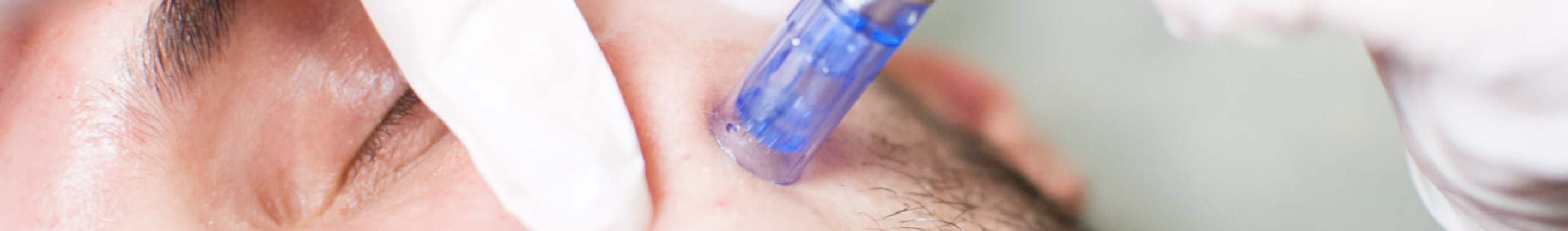 microneedling